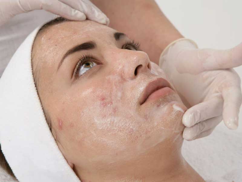 SD-chemical-peel1b