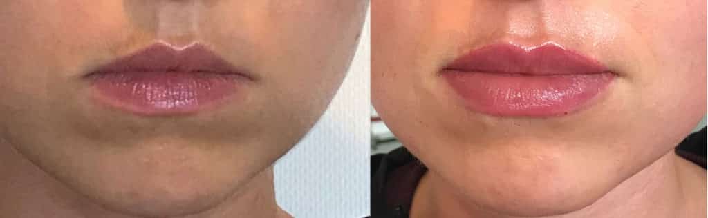 DermalFiller1ml-2