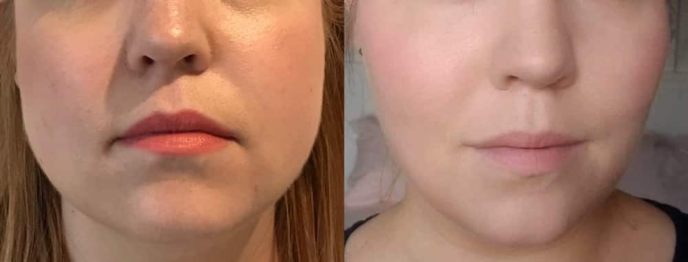 Ashley-Aesthetics-Cheeks-Dermal-Filler