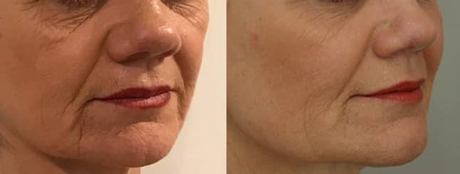 Ashley-Aesthetics-Dermal-Filler-Anti-Wrinkle-3