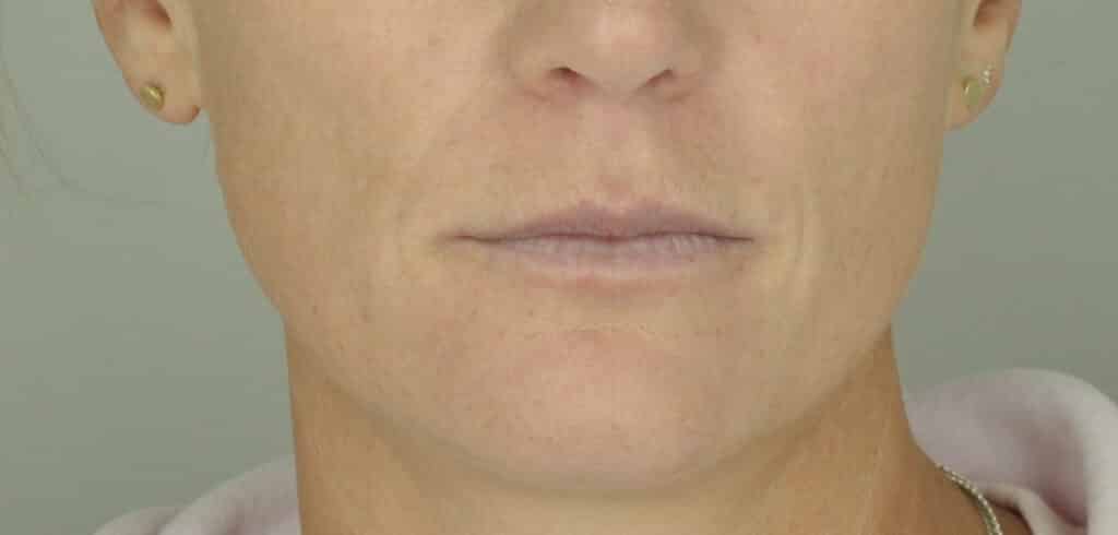 Before-Lip-Filler Before lip filler