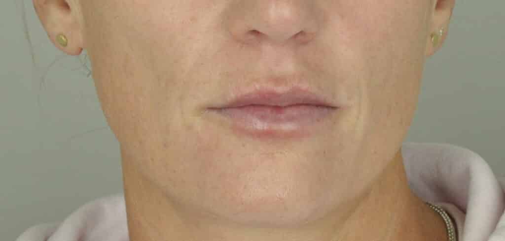 Directly-After-Lip-Filler Directly after lip filler
