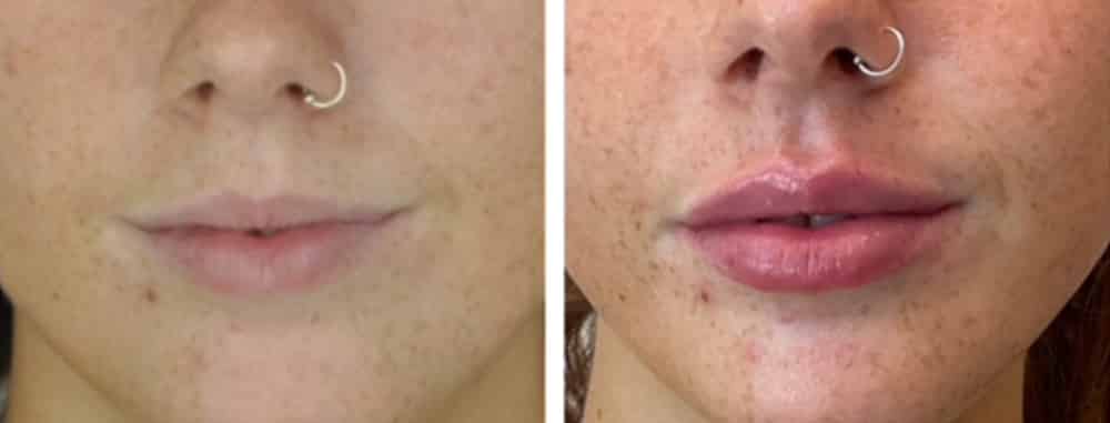 Ashley-Aesthetics-Lips-Dermal-Filler-4