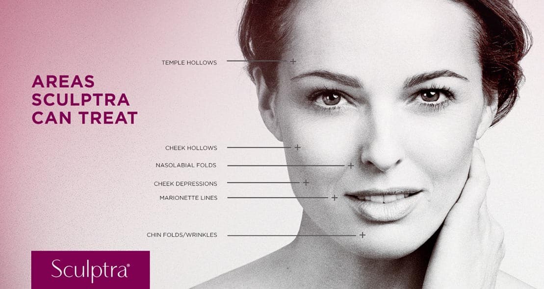 sculptra-where-face