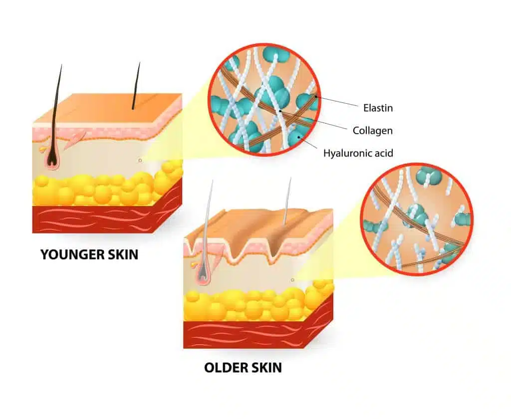 Hyaluronic-Acid-older-vs-younger-skin